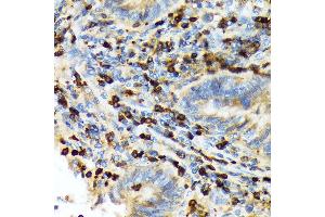 Immunohistochemistry of paraffin-embedded human colon carcinoma using T Rabbit mAb (ABIN7270916) at dilution of 1:100 (40x lens). (TACC3 antibody)