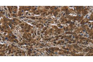 Immunohistochemistry of paraffin-embedded Human liver cancer tissue using PIP Polyclonal Antibody at dilution 1:50 (PIP antibody)