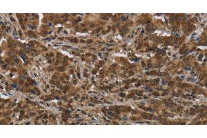 Immunohistochemistry of paraffin-embedded Human liver cancer tissue using PIP Polyclonal Antibody at dilution 1:50 (PIP antibody)