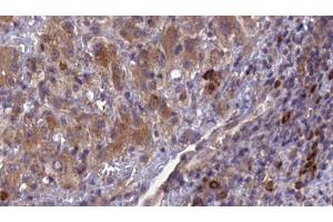 ABIN6276942 at 1/100 staining Human liver cancer tissue by IHC-P.