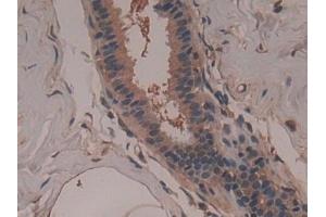 Detection of GARS in Human Breast cancer Tissue using Polyclonal Antibody to Glycyl tRNA Synthetase (GARS) (GARS antibody  (AA 567-735))