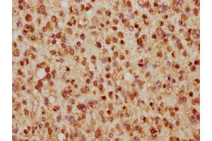 IHC image of nhibHU diluted at 1:5 and staining in paraffin-embedded human glioma cancer performed on a Leica BondTM system. (Histone H2B antibody  (AA 53-64))