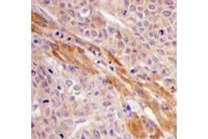 IHC analysis of FFPE human hepatocarcinoma tissue stained with PGK1 antibody (PGK1 antibody  (AA 305-334))