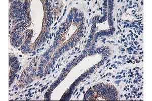 Immunohistochemical staining of paraffin-embedded Adenocarcinoma of Human endometrium tissue using anti-CCM2 mouse monoclonal antibody. (CCM2 antibody)