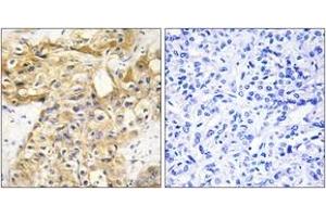 Immunohistochemistry analysis of paraffin-embedded human liver carcinoma tissue, using Collagen XVIII alpha1 Antibody. (COL18A1 antibody  (AA 801-850))