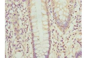 Immunohistochemistry of paraffin-embedded human colon cancer using ABIN7162208 at dilution of 1:100 (Oligophrenin 1 antibody  (AA 1-270))