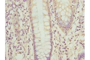 Immunohistochemistry of paraffin-embedded human colon cancer using ABIN7162208 at dilution of 1:100