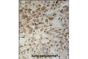 C14orf179 Antibody immunohistochemistry analysis in formalin fixed and paraffin embedded human lung carcinoma followed by peroxidase conjugation of the secondary antibody and DAB staining. (IFT43 antibody  (AA 145-171))