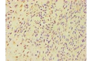 Immunohistochemistry of paraffin-embedded human breast cancer using ABIN7145262 at dilution of 1:100 (BSND antibody  (AA 54-320))