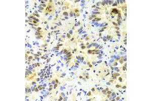 Immunohistochemistry of paraffin-embedded human lung cancer using SRSF1 Antibody (ABIN5970815) at dilution of 1/100 (40x lens). (SRSF1 antibody)