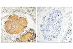 Immunohistochemical analysis of paraffin-embedded human breast carcinoma tissue, using FADD (Phospho-Ser190) antibody (left)or the same antibody preincubated with blocking peptide (right). (FADD antibody  (pSer191))