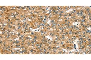 Immunohistochemistry of paraffin-embedded Human liver cancer tissue using RASSF9 Polyclonal Antibody at dilution 1:45 (RASSF9 antibody)