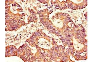 Immunohistochemistry of paraffin-embedded human colon cancer using ABIN7169453 at dilution of 1:100 (SH2D1B antibody  (AA 1-77))