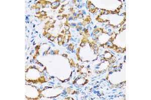 Immunohistochemistry of paraffin-embedded human thyroid cancer using PIST/GOPC Rabbit mAb (ABIN1678809, ABIN1678808, ABIN7101325 and ABIN7101326) at dilution of 1:100 (40x lens). (GOPC antibody)