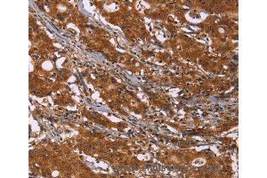 Immunohistochemistry of Human colon cancer using DCBLD2 Polyclonal Antibody at dilution of 1:50 (DCBLD2 antibody)