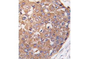 Formalin-fixed and paraffin-embedded human breast carcinoma tissue reacted with SNK Antibody (C-term ) , which was peroxidase-conjugated to the secondary antibody, followed by DAB staining. (PLK2 antibody  (C-Term))