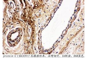 Anti-Protein C antibody, IHC(P) IHC(P): Human Mammary Cancer Tissue