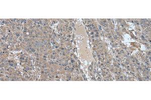 Immunohistochemistry of paraffin-embedded Human liver cancer tissue using USP32 Polyclonal Antibody at dilution of 1:75(x200) (USP32 antibody)