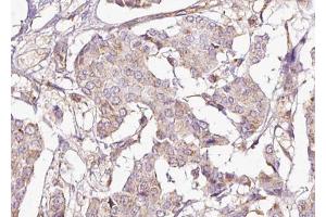 ABIN6267696 at 1/100 staining human Breast cancer tissue sections by IHC-P. (DARPP32 antibody  (pThr75))