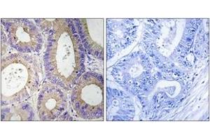 Immunohistochemistry analysis of paraffin-embedded human colon carcinoma tissue, using CBR3 Antibody. (CBR3 antibody  (AA 151-200))