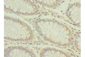 Immunohistochemistry of paraffin-embedded human colon cancer using ABIN7146772 at dilution of 1:100 (CPD antibody  (AA 860-1100))