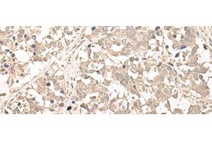 Immunohistochemistry of paraffin-embedded Human lung cancer tissue using RRP1 Polyclonal Antibody at dilution of 1:45(x200) (RRP1 antibody)