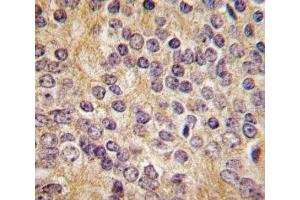 IHC analysis of FFPE human prostate carcinoma tissue stained with UPA antibody (PLAU antibody  (AA 396-426))