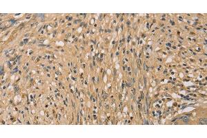 Immunohistochemistry of paraffin-embedded Human cervical cancer tissue using SETD2 Polyclonal Antibody at dilution 1:40 (SETD2 antibody)