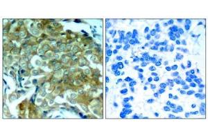 Immunohistochemical analysis of paraffin-embedded human breast carcinoma tissue, using (EGFR antibody  (pTyr1172))