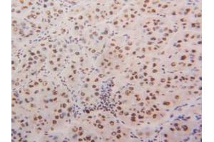 IHC-P analysis of Human Liver Cancer Tissue, with DAB staining. (HNRNPA2B1 antibody  (AA 21-103))