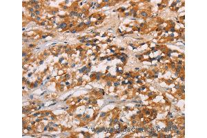 Immunohistochemistry of Human gastric cancer using CD80 Polyclonal Antibody at dilution of 1:50 (CD80 antibody)