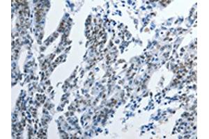 The image on the left is immunohistochemistry of paraffin-embedded Human gastric cancer tissue using ABIN7191895(PIWIL3 Antibody) at dilution 1/20, on the right is treated with synthetic peptide. (PIWIL3 antibody)