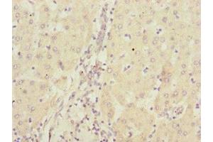 Immunohistochemistry of paraffin-embedded human liver cancer using ABIN7146746 at dilution of 1:100