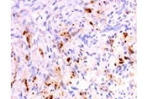 Formalin-fixed, paraffin-embedded human polyostotic sclerosing histiocytosis (Erdheim Chester disease) stained with anti-TNF alpha antibody (SPM543).
