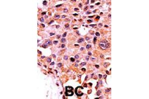 Formalin-fixed and paraffin-embedded human cancer tissue reacted with PPP3CA polyclonal antibody  , which was peroxidase-conjugated to the secondary antibody, followed by AEC staining. (PPP3CA antibody  (N-Term))