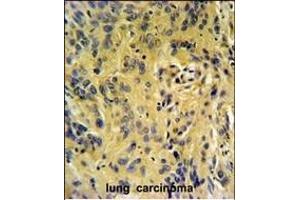 TESC Antibody (C-term) (ABIN651329 and ABIN2840191) IHC analysis in formalin fixed and paraffin embedded human lung carcinoma followed by peroxidase conjugation of the secondary antibody and DAB staining. (Tescalcin antibody  (C-Term))