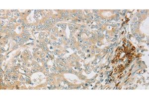 Immunohistochemistry of paraffin-embedded Human gastric cancer tissue using AMPK alpha1 Polyclonal Antibody at dilution 1:70 (PRKAA1 antibody)