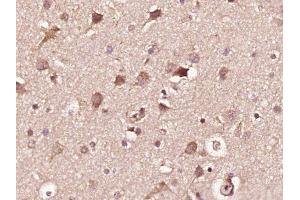 Paraformaldehyde-fixed, paraffin embedded human glioma, Antigen retrieval by boiling in sodium citrate buffer (pH6) for 15min, Block endogenous peroxidase by 3% hydrogen peroxide for 30 minutes,  Blocking buffer (normal goat serum) at 37°C for 20min, Antibody incubation with INPPL1(Tyr1135) Polyclonal Antibody (bs-3399R) at 1:400 overnight at 4°C, followed by a conjugated secondary and DAB staining. (INPPL1 antibody  (pTyr1135))