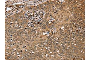 The image on the left is immunohistochemistry of paraffin-embedded Human cervical cancer tissue using ABIN7191664(NMT1 Antibody) at dilution 1/45, on the right is treated with synthetic peptide. (NMT1 antibody)