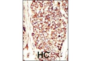 Formalin-fixed and paraffin-embedded human cancer tissue reacted with the primary antibody, which was peroxidase-conjugated to the secondary antibody, followed by AEC staining. (ErbB2/Her2 antibody  (N-Term))