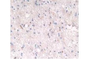 Detection of LRP4 in Human Glioma Tissue using Polyclonal Antibody to Low Density Lipoprotein Receptor Related Protein 4 (LRP4) (LRP4 antibody  (AA 1610-1885))