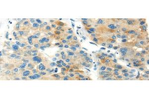 Immunohistochemistry of paraffin-embedded Human liver cancer using PDPN Polyclonal Antibody at dilution of 1/20 (Podoplanin antibody)