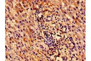 Immunohistochemistry of paraffin-embedded human liver cancer using ABIN7176118 at dilution of 1:100 (ZNF155 antibody  (AA 1-538))
