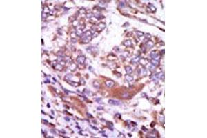 Formalin-fixed and paraffin-embedded human cancer tissue (hepatocarcinoma) reacted with the primary antibody, which was peroxidase-conjugated to the secondary antibody, followed by AEC staining. (CAMK2D antibody  (C-Term))