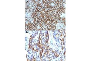 Immunohistochemical staining (Formalin-fixed paraffin-embedded sections) of (A) human melanoma and (B) human tongue with Melanoma monoclonal antibody, clone KBA. (Melanoma antibody)
