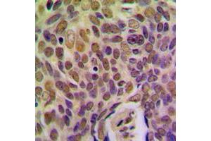 Immunohistochemical analysis of BRMS1 staining in human breast cancer formalin fixed paraffin embedded tissue section. (BRMS1 antibody  (Center))