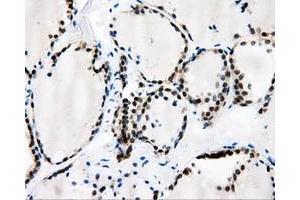 Immunohistochemical staining of paraffin-embedded Adenocarcinoma of breast tissue using anti-CAMK1D mouse monoclonal antibody. (CAMK1D antibody)