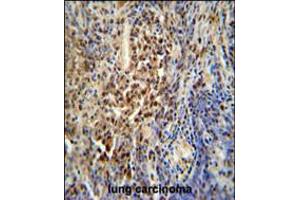 PUS3 antibody immunohistochemistry analysis in formalin fixed and paraffin embedded human lung carcinoma followed by peroxidase conjugation of the secondary antibody and DAB staining. (PUS3 antibody  (N-Term))