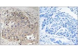 Immunohistochemistry analysis of paraffin-embedded human lung carcinoma, using SPTBN5 Antibody.