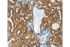 Immunohistochemistry of Human liver cancer using CLPTM1L Polyclonal Antibody at dilution of 1:60 (CLPTM1L antibody)